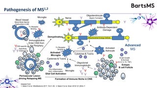 Perivascular Lesion
driving Relapsing MS
Blood Vessel
Blood Brain Barrier
Dysfunction in MS
Immunglobulins
Enter CNS from
the Periphery
Y
Y
YY
Y
Y
Y
Y
Antibody-Dependent
Damage
Y
Microglia
Y
Y
Y
Y
Y
CNS-specific Ig
Specificity
Irrelevant Ig
Mitochondrial Energy DeficitsDemyelination
Nerve
Oligodendrocyte
Myelin Formation
Y
Y
Y
Fc Receptor
Binding
Advanced
MS
Adapted from:
1. Baker D et al. EBioMedicine 2017; 16:41–50; 2. Baker D et al. Brain 2018;141:2834–7.
Y
Y
Y
Activated
Microglia
Pro-Inflammation
Anti—Inflammation
Glial Cell Activation
Cytokines & Toxins
Cytokines & Toxins
Activated
Astrocyte
Fc Receptor
Binding
Microglia
Ectopic
B cell Follicle
B cell Growth
& Survival
(IL-6, IL-10, TNF)
Y
YY
Y Y
Oligoclonal
Immunoglobulin
Formation of Immune Niche in CNS
Pathogenesis of MS1,2
 