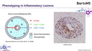Phenotyping in Inflammatory Lesions
Courtesy of Sandra Amor, NL
CD20 B Cells
B Cells
CD4+ T Cells
CD8+ T Cells
Active Demyelination
Active Lesions(Relapsing MS)
Demyelinated
Machado-Santos J et al. Brain 2018; 141:20661
 