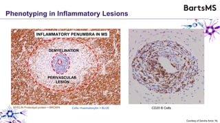 Phenotyping in Inflammatory Lesions
Courtesy of Sandra Amor, NL
CD20 B Cells
B Cells
CD4+ T Cells
CD8+ T Cells
Active Demyelination
Active Lesions(Relapsing MS)
Demyelinated
Machado-Santos J et al. Brain 2018; 141:20661
INFLAMMATORY PENUMBRA IN MS
MYELIN Proteolipid protein = BROWN
DEMYELINATION
PERIVASCULAR
LESION
RELAPSING MSCells =haematoxylin = BLUE
 