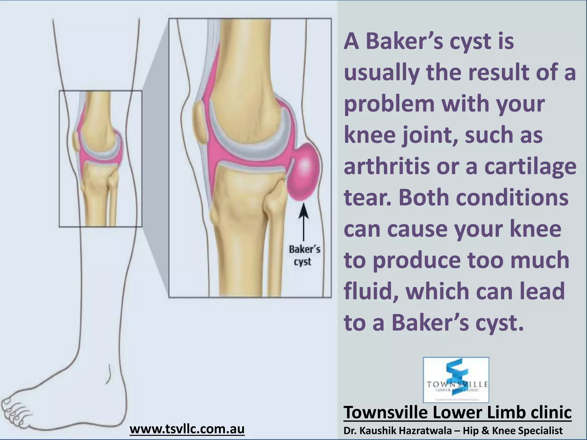 Bakers Cyst of The Knee