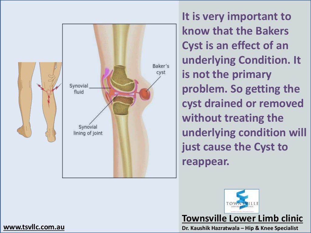 Baker s Cyst Anatomy At Sam Jimenez Blog Baker s Cyst Anatomy At Sam Jimenez Blog