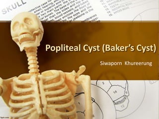 Popliteal Cyst (Baker’s Cyst)
Siwaporn Khureerung
 