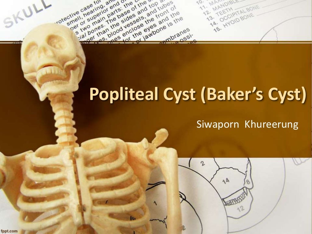 Baker's cyst