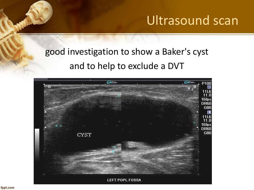 Baker's cyst