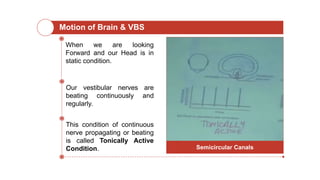 Motion of Brain & VBS
When we are looking
Forward and our Head is in
static condition.
Our vestibular nerves are
beating continuously and
regularly.
This condition of continuous
nerve propagating or beating
is called Tonically Active
Condition. Semicircular Canals
 