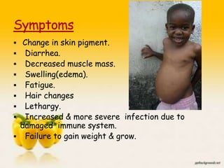  Change in skin pigment.
 Diarrhea.
 Decreased muscle mass.
 Swelling(edema).
 Fatigue.
 Hair changes
 Lethargy.
 Increased & more severe infection due to
damaged immune system.
 Failure to gain weight & grow.
22
 