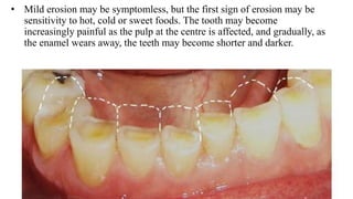 • Mild erosion may be symptomless, but the first sign of erosion may be
sensitivity to hot, cold or sweet foods. The tooth may become
increasingly painful as the pulp at the centre is affected, and gradually, as
the enamel wears away, the teeth may become shorter and darker.
 