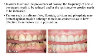 • In order to reduce the prevalence of erosion the frequency of acidic
beverages needs to be reduced and/or the resistance to erosion needs
to be increased.
• Factors such as salivary flow, fluoride, calcium and phosphate may
protect against erosion although there is no consensus as to how
effective these factors are in prevention.
 