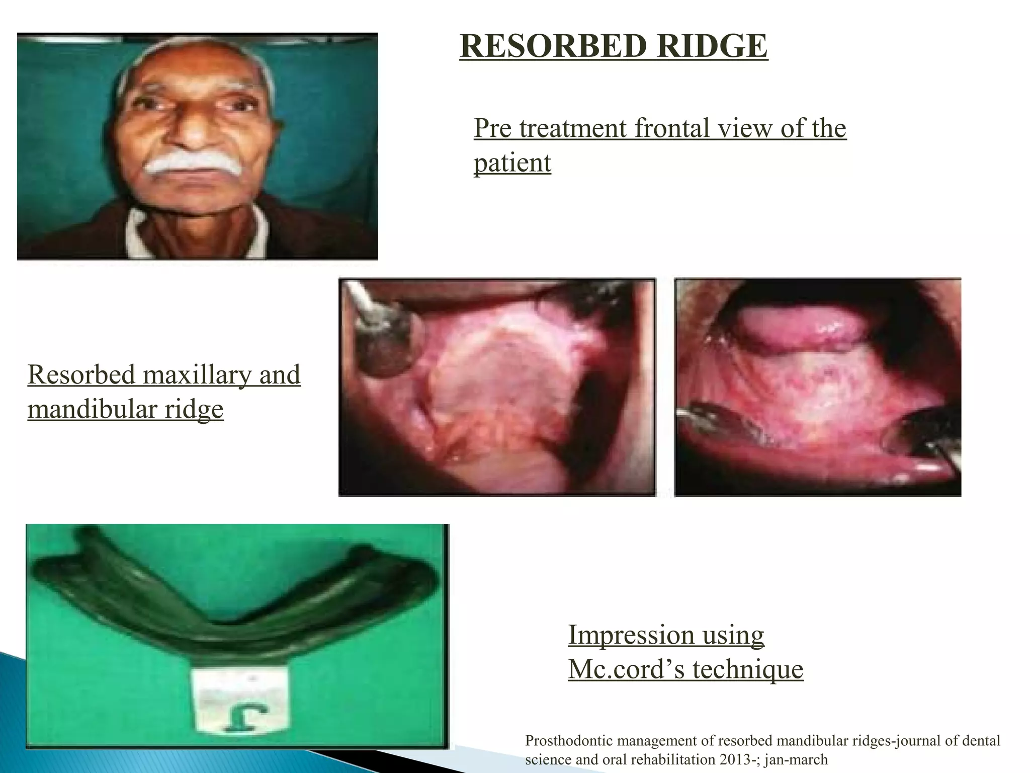Pre treatment frontal view of the
patient
Resorbed maxillary and
mandibular ridge
Impression using
Mc.cord’s technique
Prosthodontic management of resorbed mandibular ridges-journal of dental
science and oral rehabilitation 2013-; jan-march
RESORBED RIDGE
 
