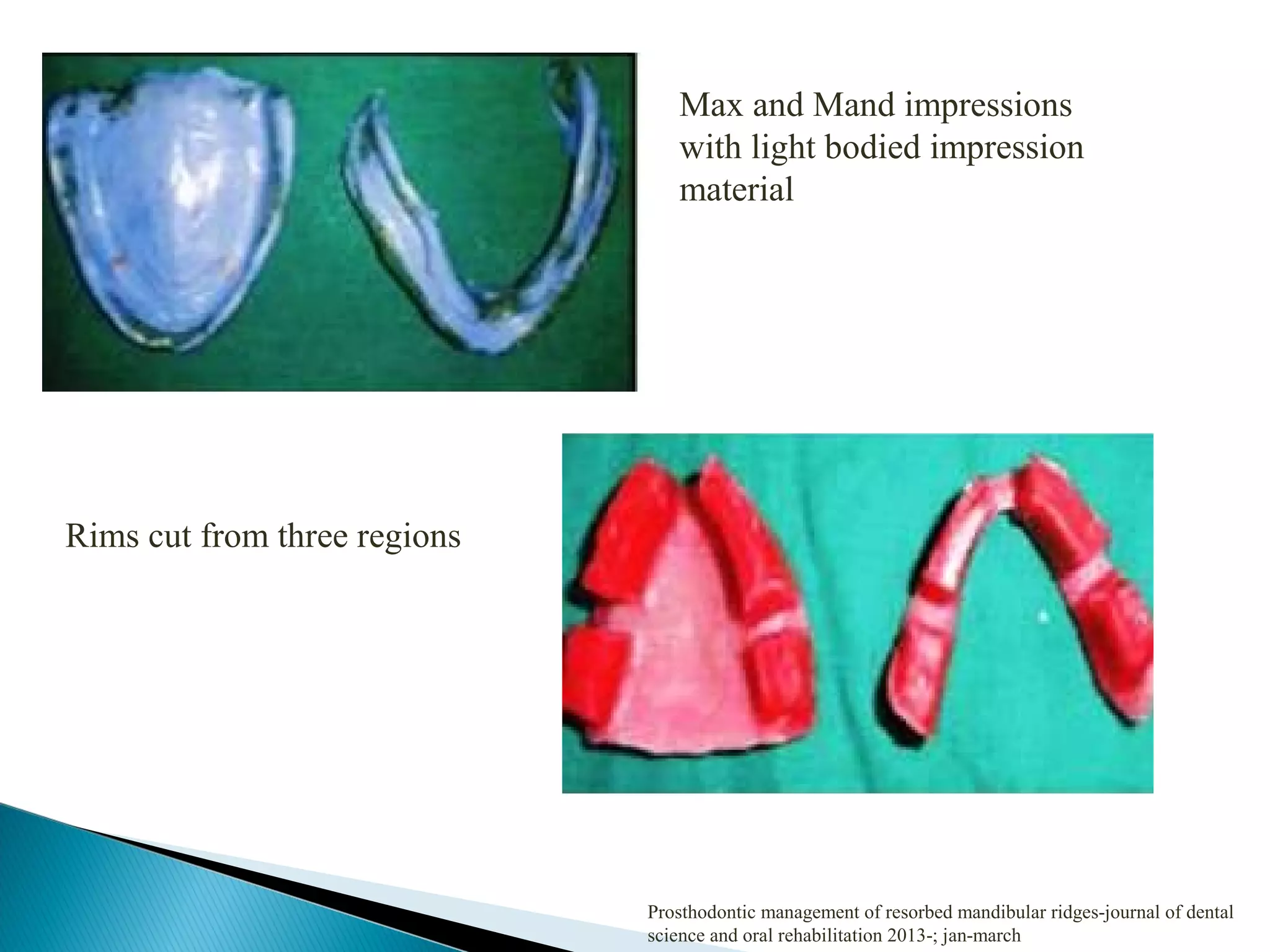 Max and Mand impressions
with light bodied impression
material
Rims cut from three regions
Prosthodontic management of resorbed mandibular ridges-journal of dental
science and oral rehabilitation 2013-; jan-march
 