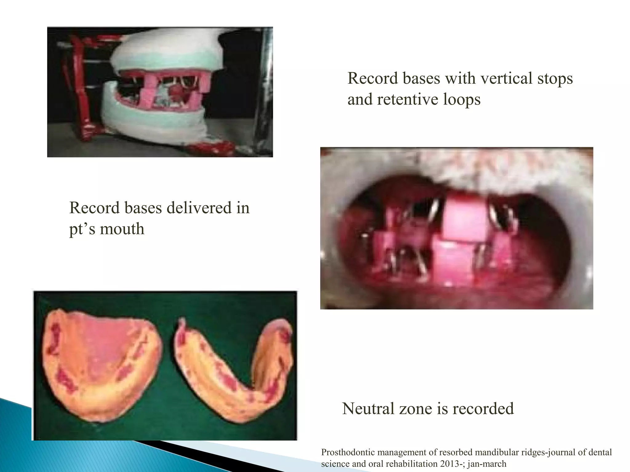 Record bases with vertical stops
and retentive loops
Record bases delivered in
pt’s mouth
Neutral zone is recorded
Prosthodontic management of resorbed mandibular ridges-journal of dental
science and oral rehabilitation 2013-; jan-march
 