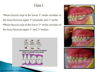 •Mesio buccal cusp of the lower 1st
molar occludes in
the fossa between upper 2nd
premolar and 1st
molar.
•Mesio buccal cusp of the lower 2nd
molar occludes in
the fossa between upper 1st
and 2nd
molars.
Class 1
Sheldon winkler 2nd
edition
 