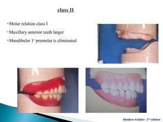 Molar relation class I
Maxillary anterior teeth larger
Mandibular 1st
premolar is eliminated
class II
Sheldon winkler 2nd
edition
 