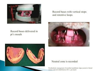 Record bases with vertical stops
and retentive loops
Record bases delivered in
pt’s mouth
Neutral zone is recorded
Prosthodontic management of resorbed mandibular ridges-journal of dental
science and oral rehabilitation 2013-; jan-march
 
