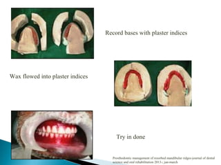 Record bases with plaster indices
Wax flowed into plaster indices
Try in done
Prosthodontic management of resorbed mandibular ridges-journal of dental
science and oral rehabilitation 2013-; jan-march
 