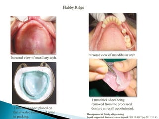 Flabby Ridge
Intraoral view of maxillary arch.
Intraoral view of mandibular arch.
1 mm thick sheet placed on
the invested master cast prior
to packing.
1 mm thick sheet being
removed from the processed
denture at recall appointment.
Management of flabby ridges using
liquid supported denture: a case report DOI:10.4047/jap.2011.3.1.43
 