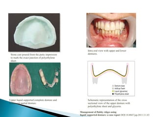 Stone cast poured from the putty impression
to mark the exact junction of polyethylene
sheet.
Intra oral view with upper and lower
dentures.
Upper liquid supported complete denture and
lower cast partial denture.
Schematic representation of the cross
sectional view of the upper denture with
polyethylene sheet and glycerin.
Management of flabby ridges using
liquid supported denture: a case report DOI:10.4047/jap.2011.3.1.43
 