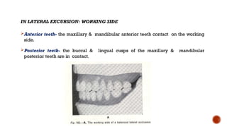 IN LATERAL EXCURSION: WORKING SIDE
Anterior teeth- the maxillary & mandibular anterior teeth contact on the working
side.
Posterior teeth- the buccal & lingual cusps of the maxillary & mandibular
posterior teeth are in contact.
 
