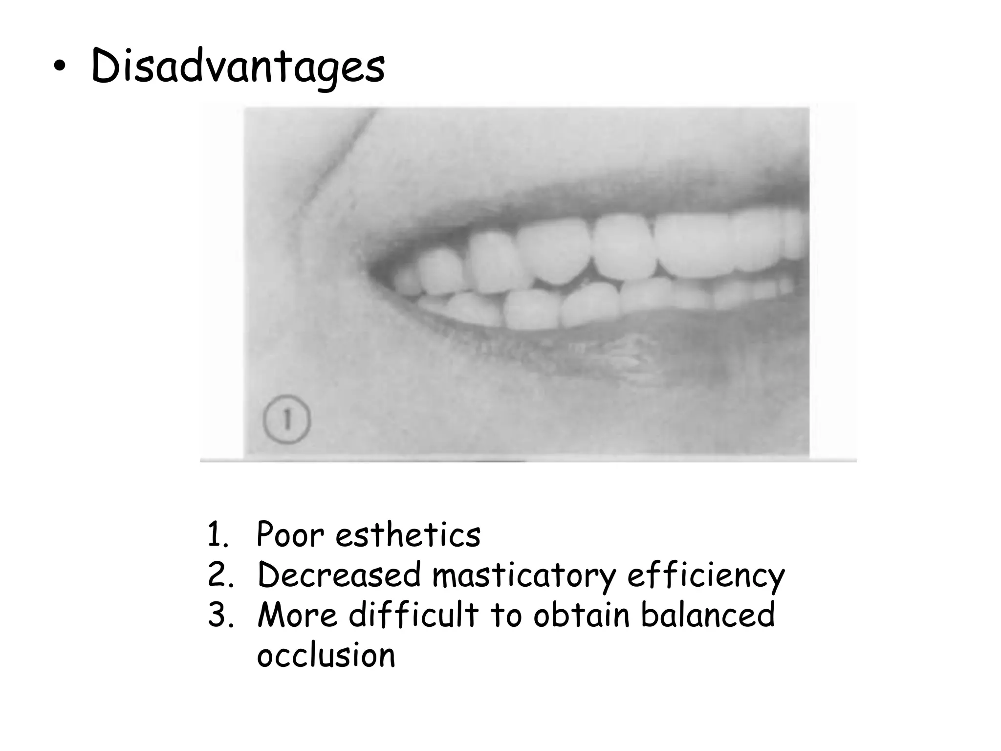 • Disadvantages 
1. Poor esthetics 
2. Decreased masticatory efficiency 
3. More difficult to obtain balanced 
occlusion 
 