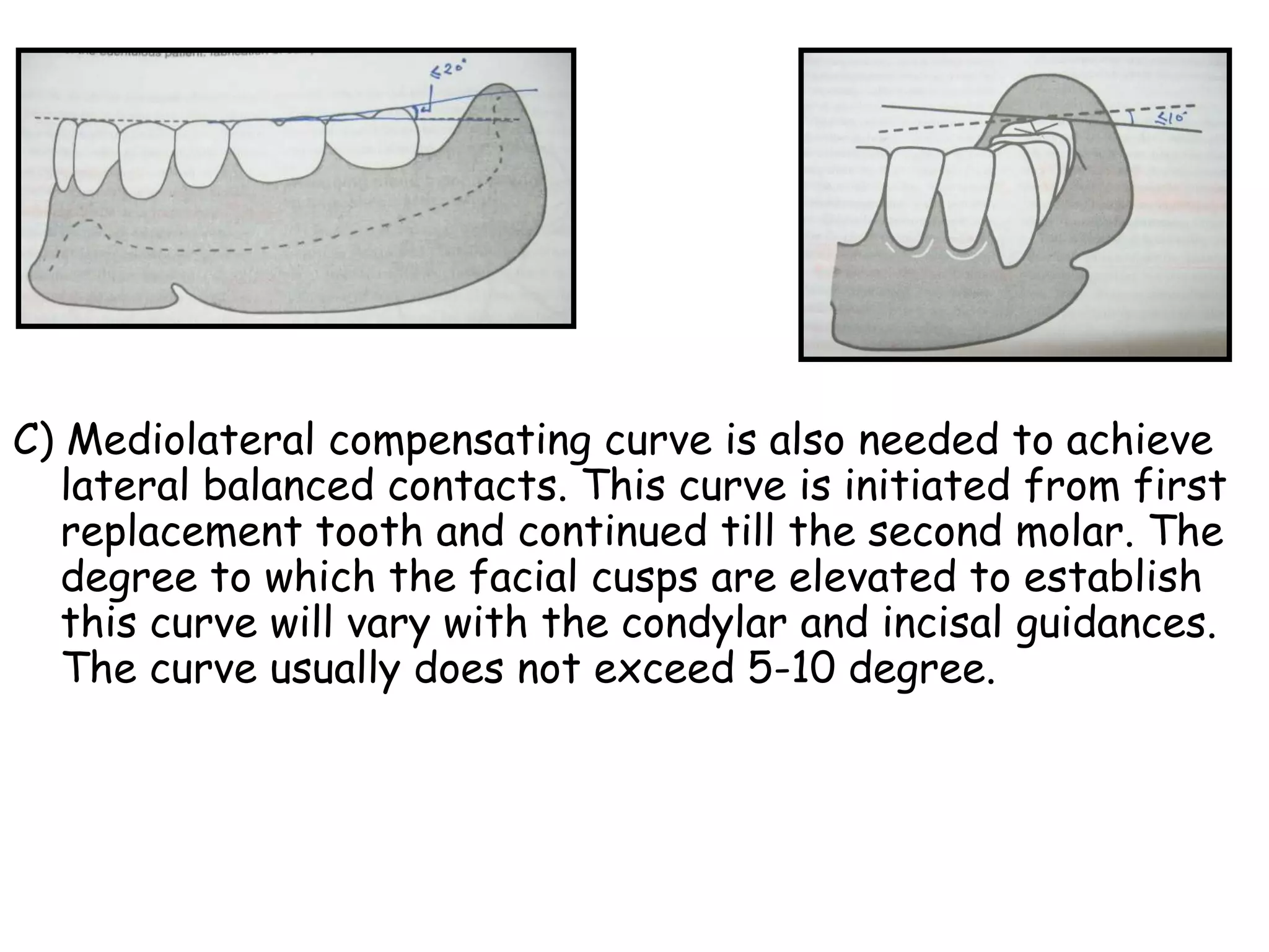 C) Mediolateral compensating curve is also needed to achieve 
lateral balanced contacts. This curve is initiated from first 
replacement tooth and continued till the second molar. The 
degree to which the facial cusps are elevated to establish 
this curve will vary with the condylar and incisal guidances. 
The curve usually does not exceed 5-10 degree. 
 