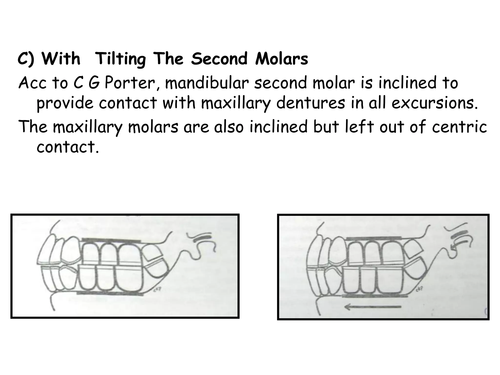 C) With Tilting The Second Molars 
Acc to C G Porter, mandibular second molar is inclined to 
provide contact with maxillary dentures in all excursions. 
The maxillary molars are also inclined but left out of centric 
contact. 
 