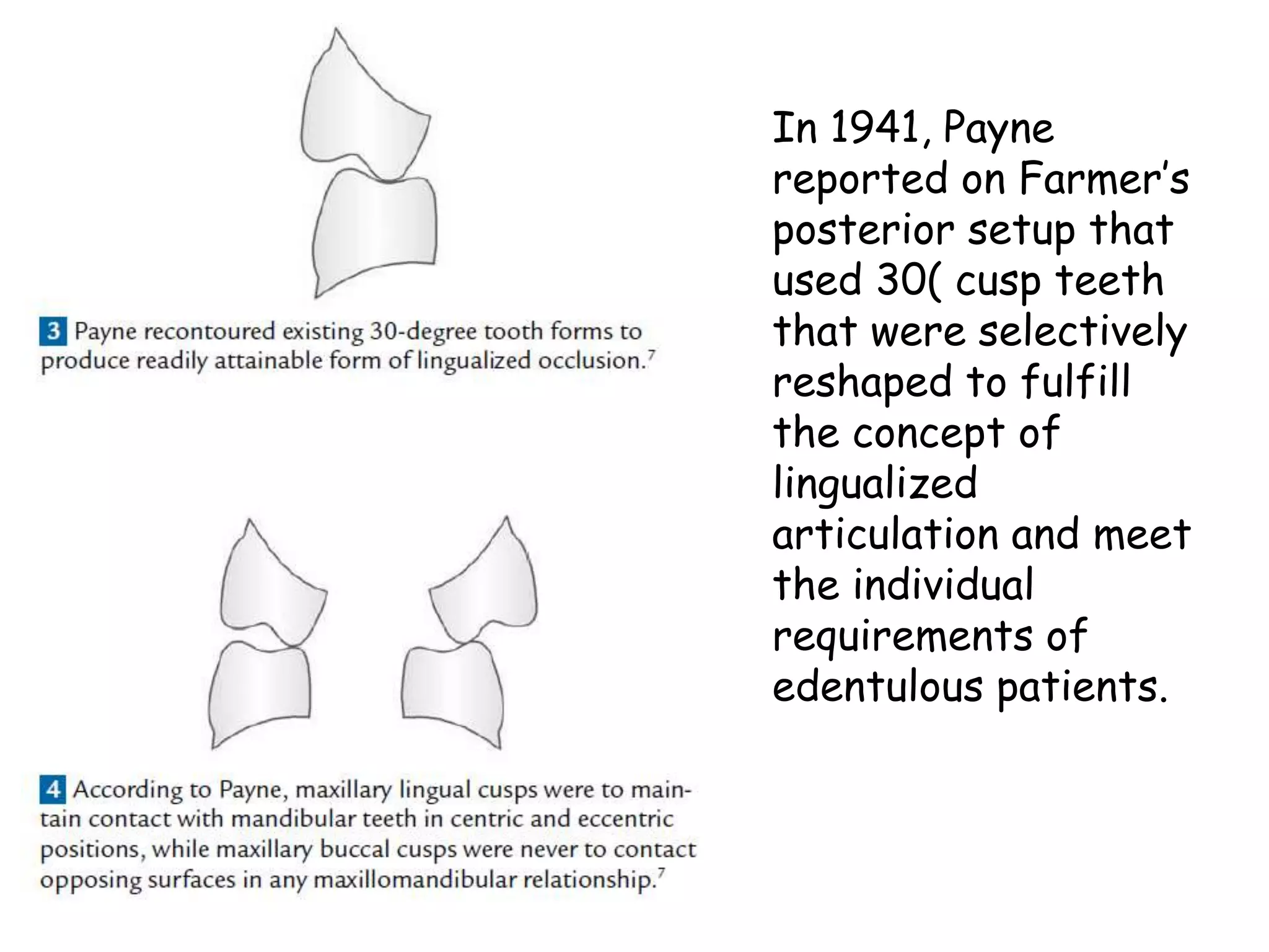 In 1941, Payne 
reported on Farmer’s 
posterior setup that 
used 30( cusp teeth 
that were selectively 
reshaped to fulfill 
the concept of 
lingualized 
articulation and meet 
the individual 
requirements of 
edentulous patients. 
 