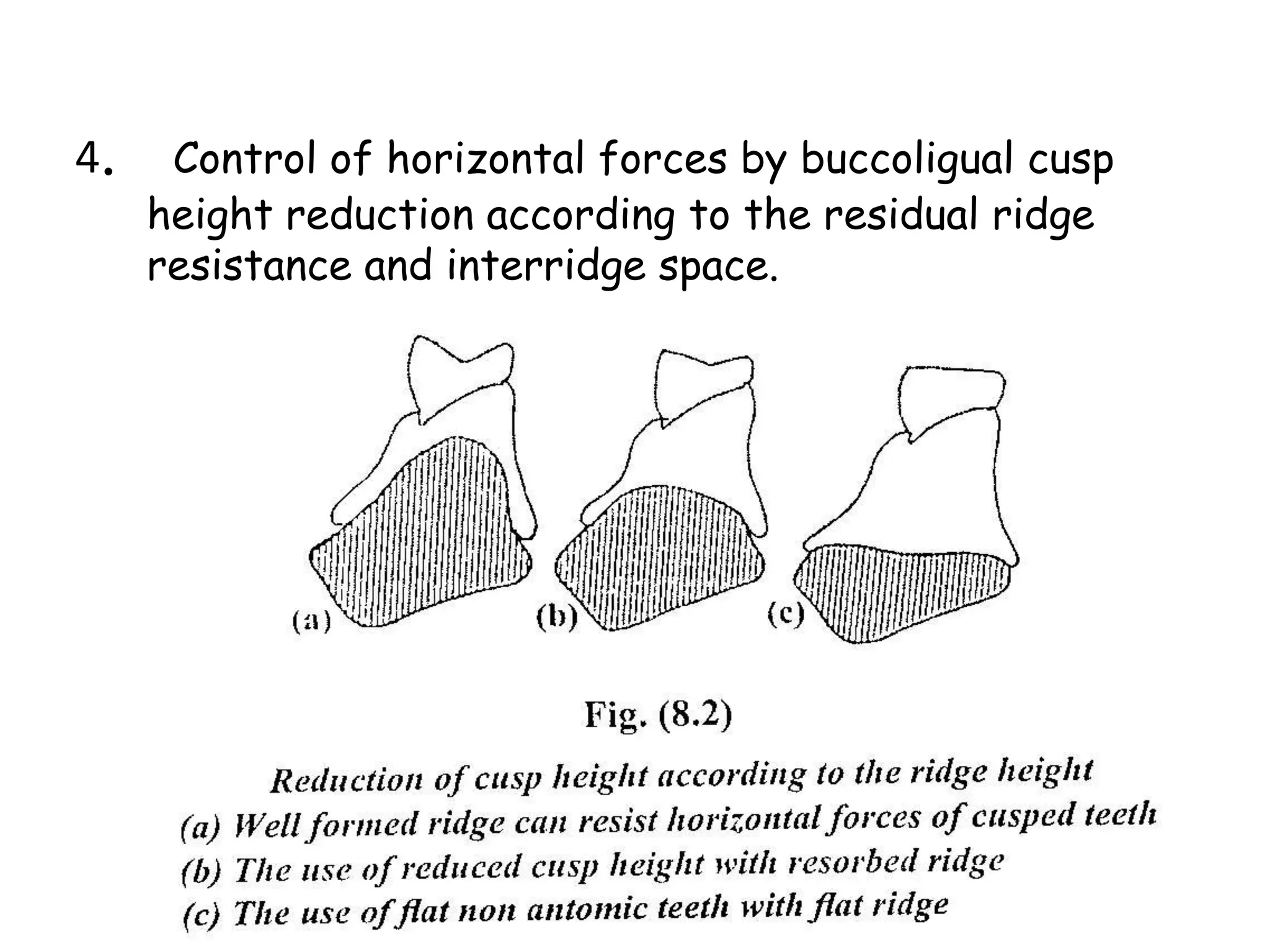 4. Control of horizontal forces by buccoligual cusp 
height reduction according to the residual ridge 
resistance and interridge space. 
 