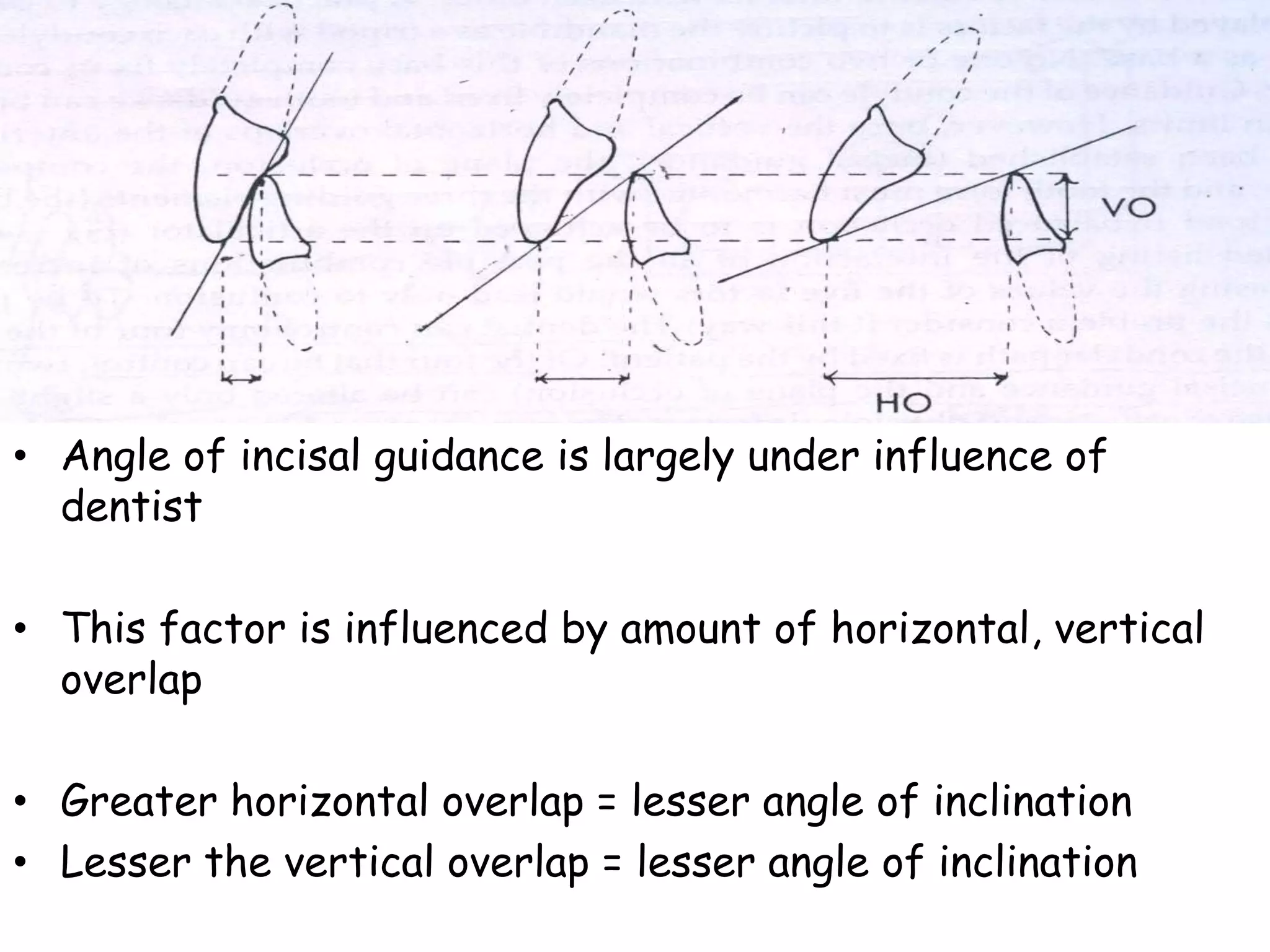• Angle of incisal guidance is largely under influence of 
dentist 
• This factor is influenced by amount of horizontal, vertical 
overlap 
• Greater horizontal overlap = lesser angle of inclination 
• Lesser the vertical overlap = lesser angle of inclination 
 