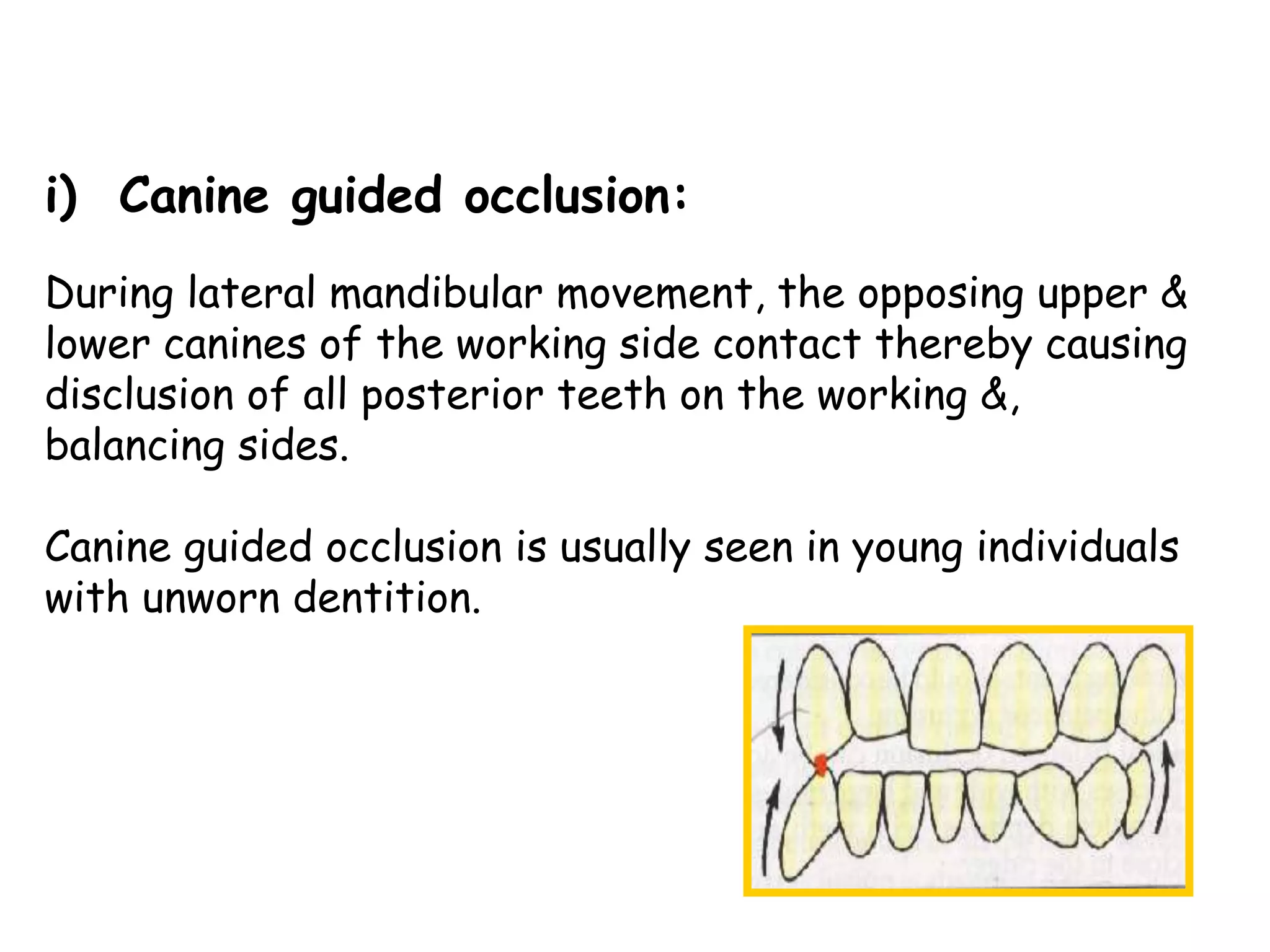 i) Canine guided occlusion: 
During lateral mandibular movement, the opposing upper & 
lower canines of the working side contact thereby causing 
disclusion of all posterior teeth on the working &, 
balancing sides. 
Canine guided occlusion is usually seen in young individuals 
with unworn dentition. 
 