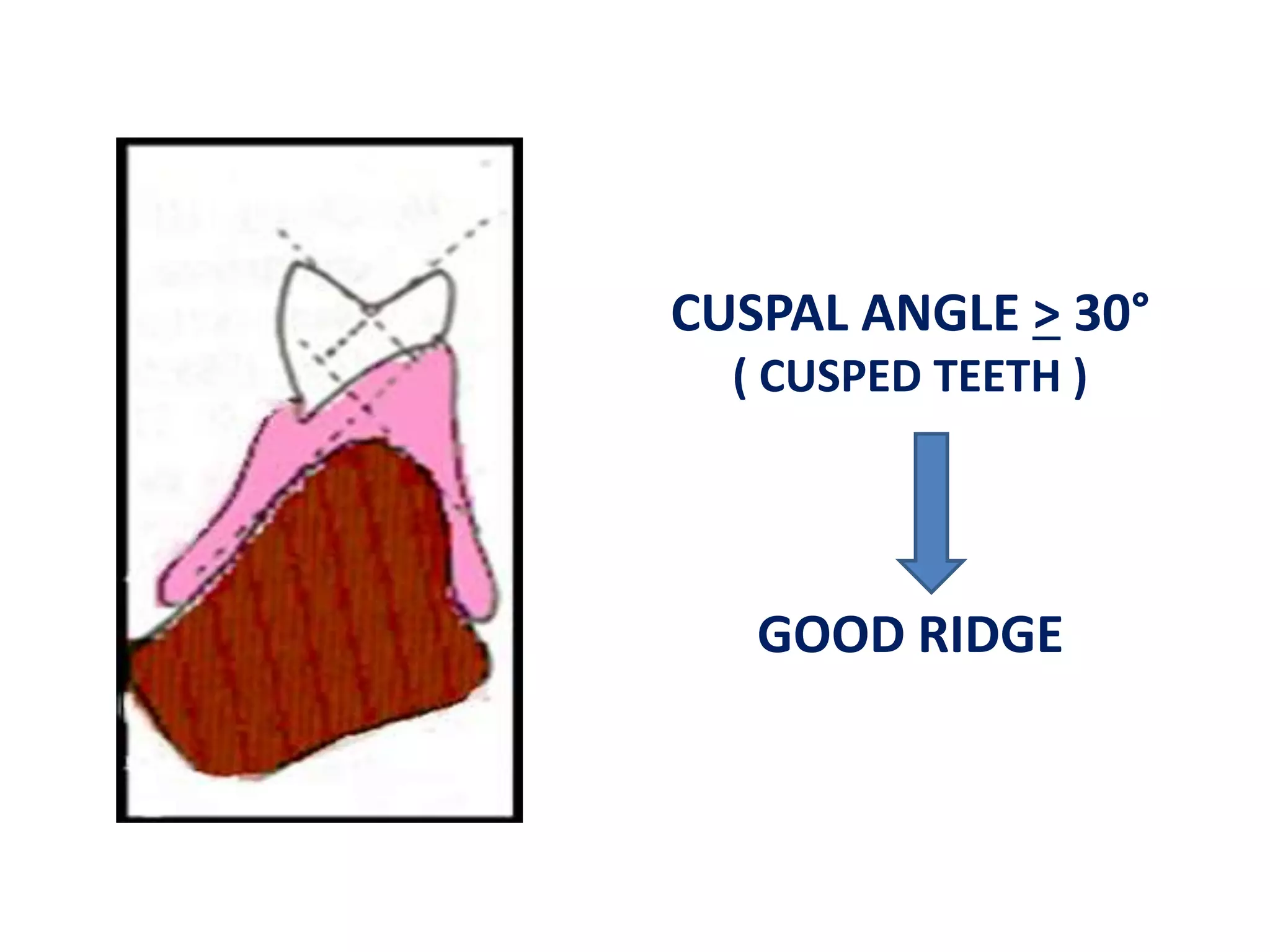 CUSPAL ANGLE > 30° 
( CUSPED TEETH ) 
GOOD RIDGE 
 