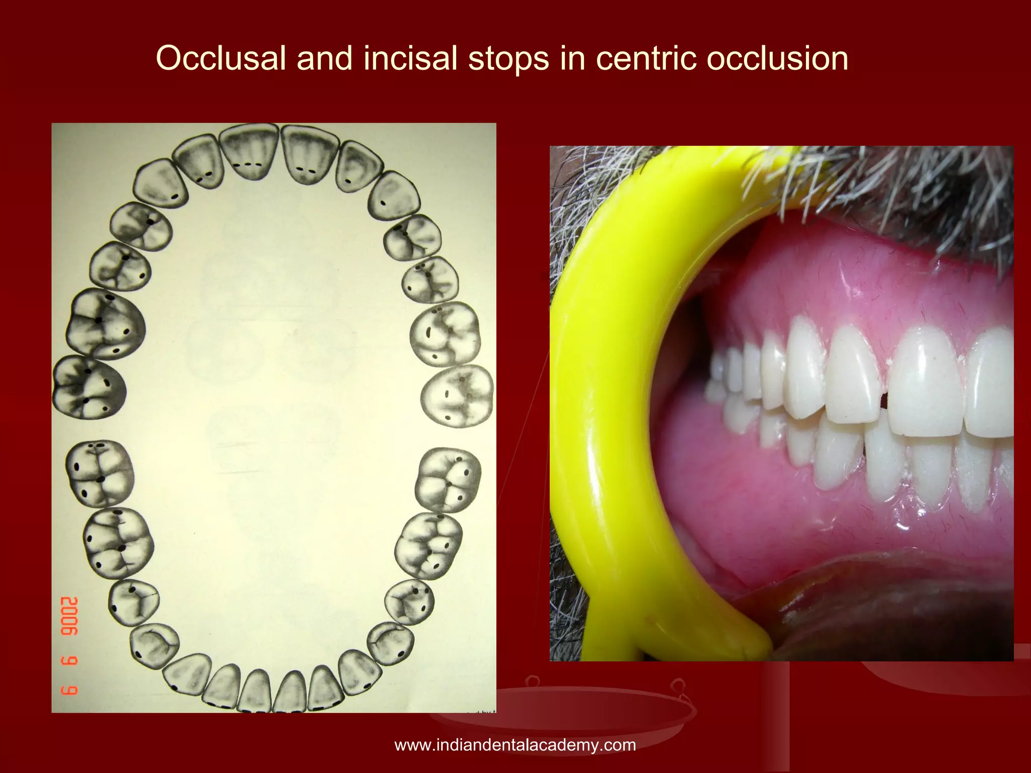 Occlusal and incisal stops in centric occlusion
www.indiandentalacademy.com
 