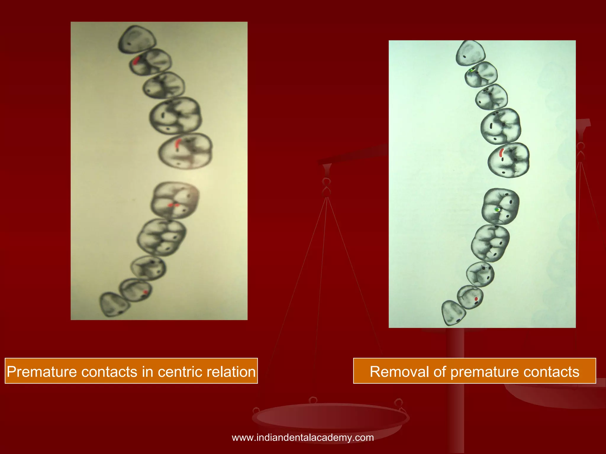 Premature contacts in centric relation Removal of premature contacts
www.indiandentalacademy.com
 