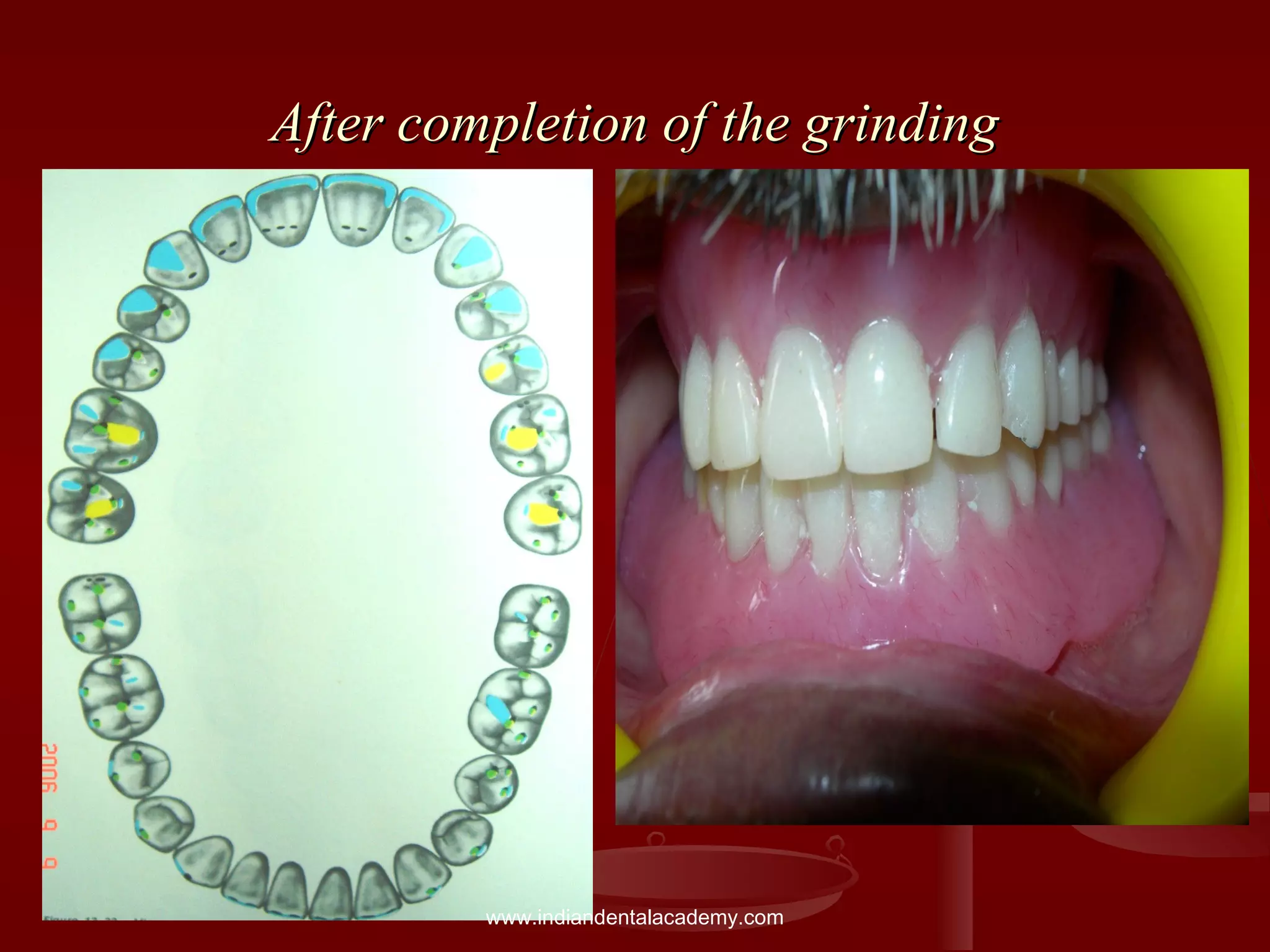 After completion of the grindingAfter completion of the grinding
www.indiandentalacademy.com
 
