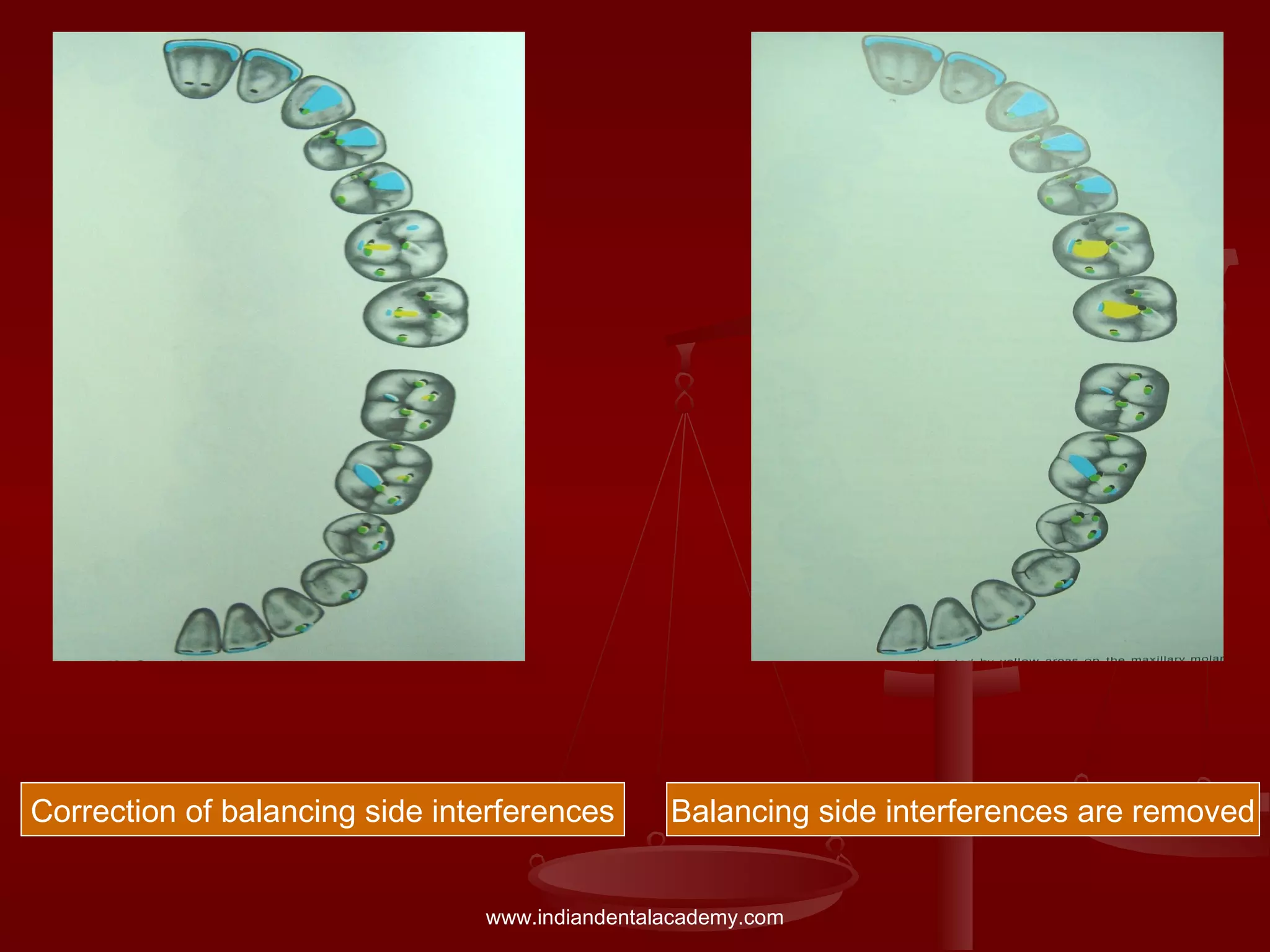 Balancing side interferences are removedCorrection of balancing side interferences
www.indiandentalacademy.com
 