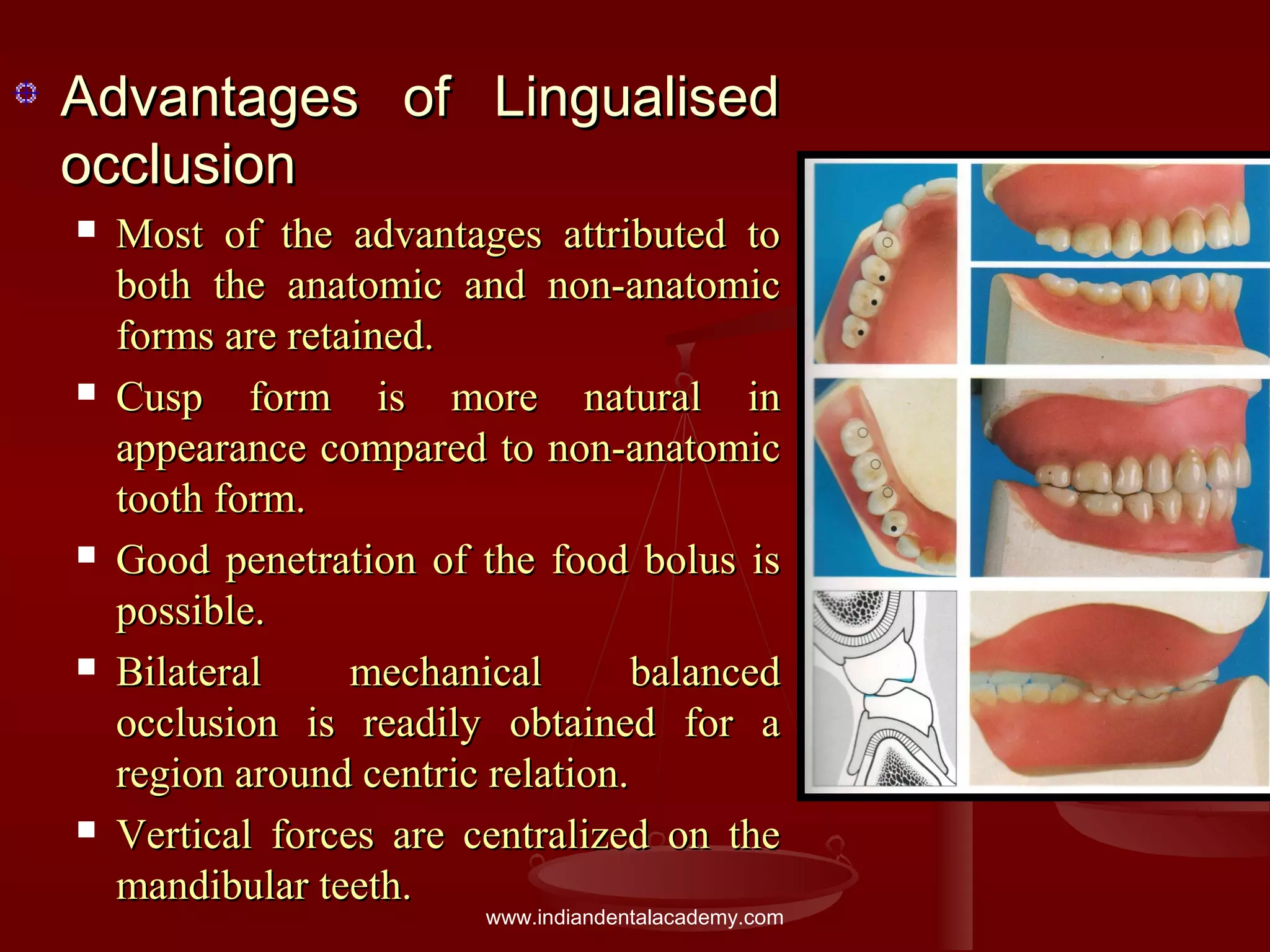 Advantages of LingualisedAdvantages of Lingualised
occlusionocclusion
 Most of the advantages attributed toMost of the advantages attributed to
both the anatomic and non-anatomicboth the anatomic and non-anatomic
forms are retained.forms are retained.
 Cusp form is more natural inCusp form is more natural in
appearance compared to non-anatomicappearance compared to non-anatomic
tooth form.tooth form.
 Good penetration of the food bolus isGood penetration of the food bolus is
possible.possible.
 Bilateral mechanical balancedBilateral mechanical balanced
occlusion is readily obtained for aocclusion is readily obtained for a
region around centric relation.region around centric relation.
 Vertical forces are centralized on theVertical forces are centralized on the
mandibular teeth.mandibular teeth.
www.indiandentalacademy.com
 