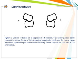 Figure : Centric occlusion in a lingualised articulation. The upper palatal cusps
contact the central fossae of their opposing mandibular teeth, and the buccal cusps
have been adjusted to just raise them sufficiently so that they do not take part in the
articulation.
Centric occlusion
 