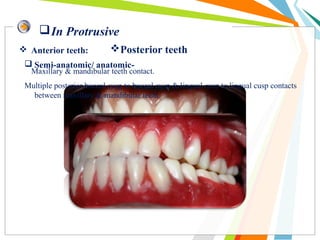 In Protrusive
 Anterior teeth:
Maxillary & mandibular teeth contact.
Posterior teeth
 Semi-anatomic/ anatomic-
Multiple posterior buccal cusp to buccal cusp & lingual cusp to lingual cusp contacts
between maxillary & mandibular teeth.
 