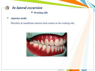 In lateral excursion
 Working side
 Anterior teeth:
Maxillary & mandibular anterior teeth contact on the working side.
 