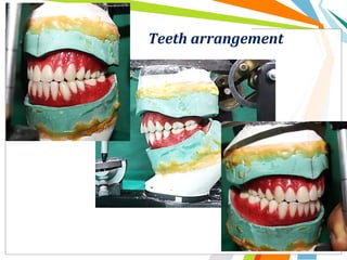 Teeth arrangement
 