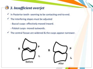 3. Insufficient overjet
 In Posterior teeth- seeming to be contacting end-to-end.
 The interfering slopes must be adjusted
- Buccal cusps- effectively moved inward.
- Palatal cusps- moved outwards.
 The central fossae are widened & the cusps appear narrower.
 