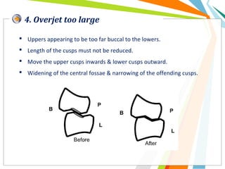 4. Overjet too large
 Uppers appearing to be too far buccal to the lowers.
 Length of the cusps must not be reduced.
 Move the upper cusps inwards & lower cusps outward.
 Widening of the central fossae & narrowing of the offending cusps.
 