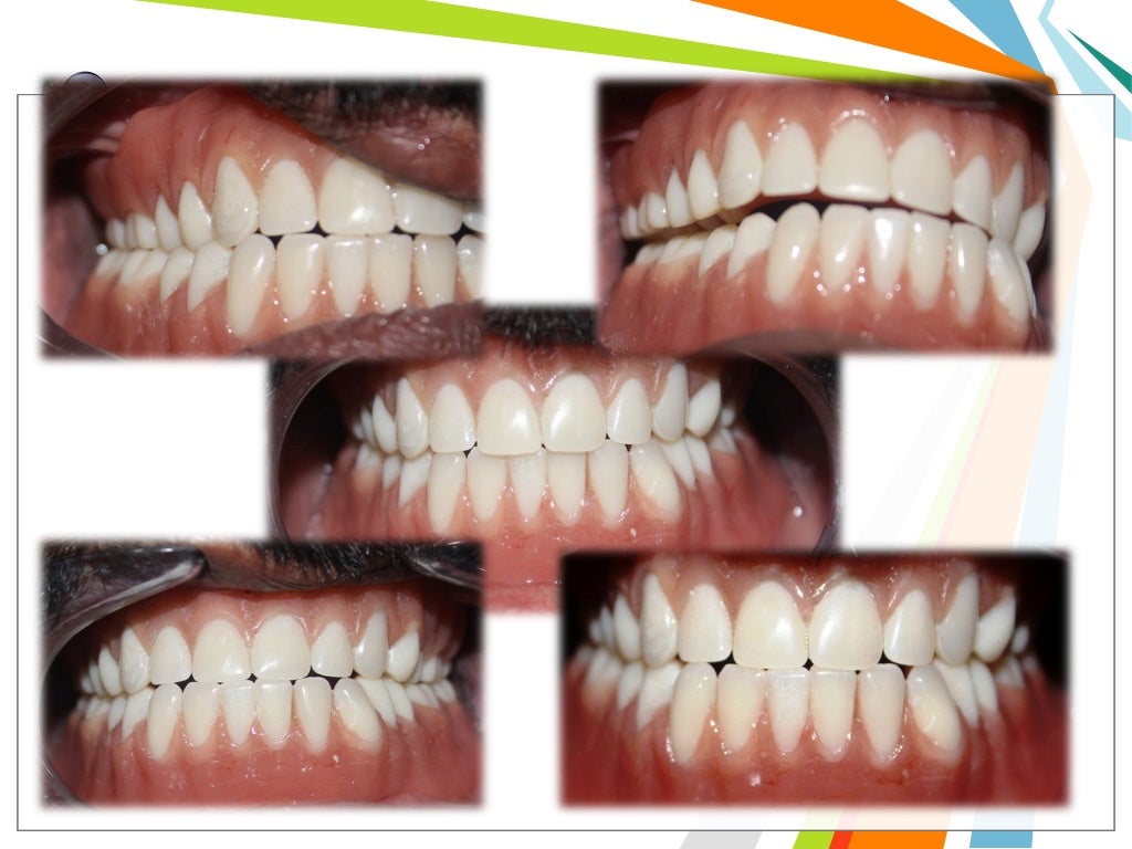 Balanced occlusion and its importance