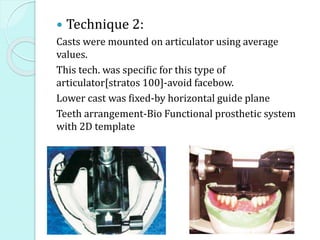  Technique 2:
Casts were mounted on articulator using average
values.
This tech. was specific for this type of
articulator[stratos 100]-avoid facebow.
Lower cast was fixed-by horizontal guide plane
Teeth arrangement-Bio Functional prosthetic system
with 2D template
 
