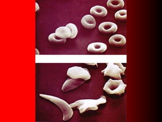 Balancing selection, sickle cell anemia, and the African slave trade as ...