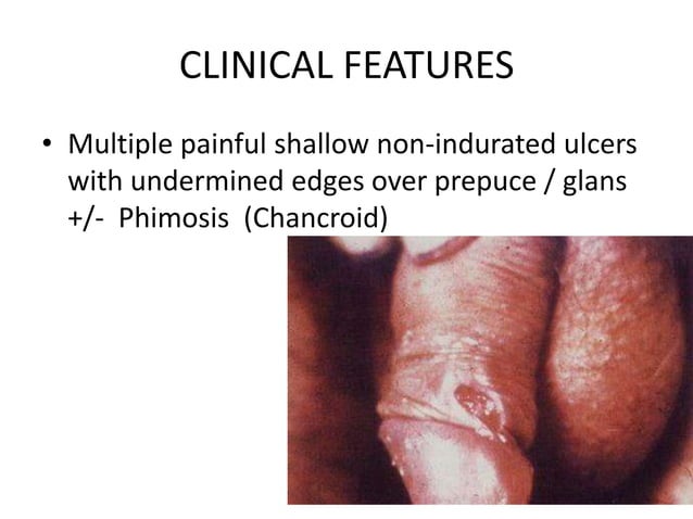 Balanoposthitis by Aseem | PPTX | Skin and Dermatology | Diseases and ...