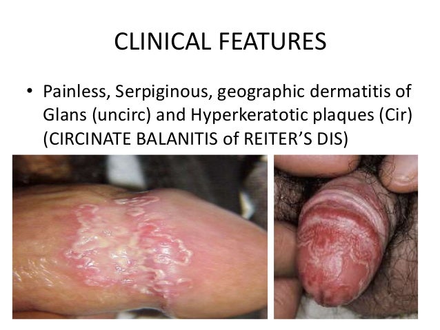 Balanitis and balanoposthitis: a review - Circumcision