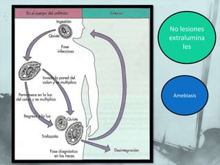 No lesiones extraluminalesAmebiasis