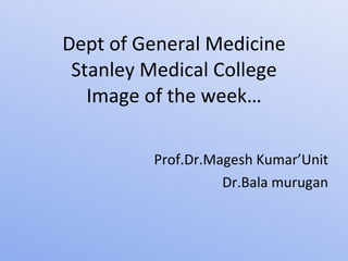 Dept of General Medicine Stanley Medical College Image of the week… Prof.Dr.Magesh Kumar’Unit Dr.Bala murugan 