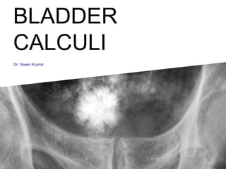 BLADDER
CALCULI
Dr. Nawin Kumar
 