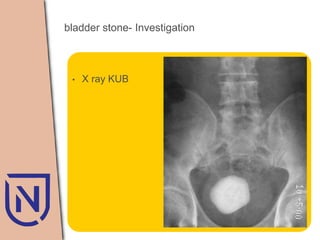 Baldder calculi neo | PPTX